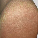 EUCERIN UreaRepair PLUS Mousse Pieds 10% d’Urée